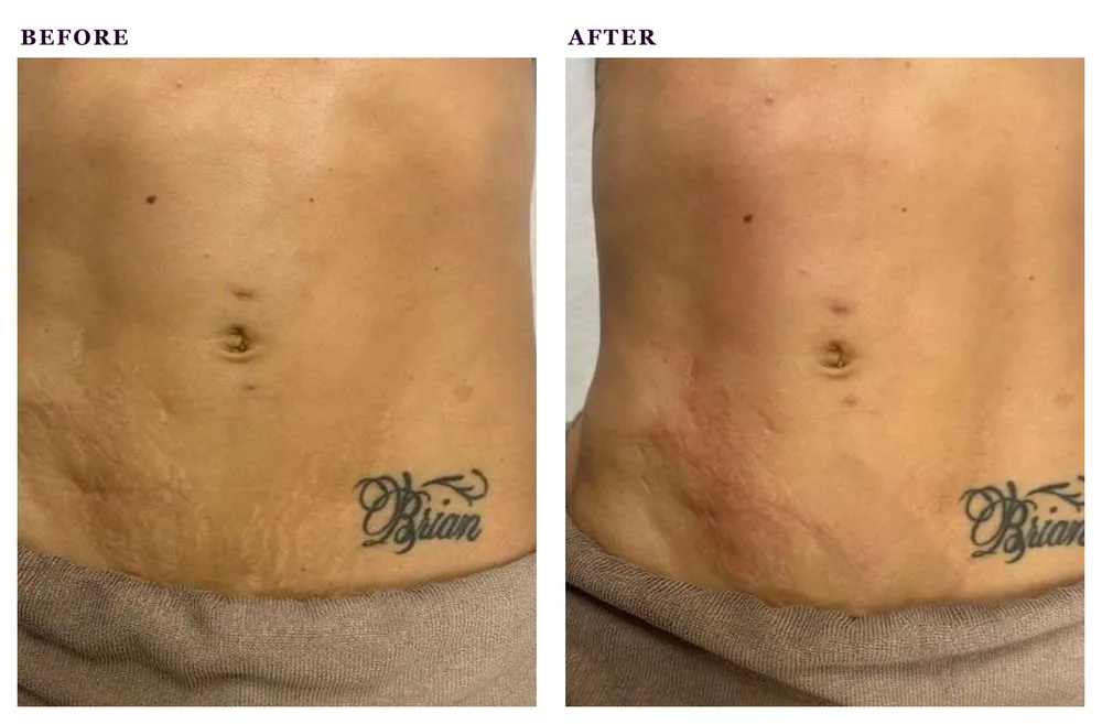 Before and after photos combining lymphatic drainage with radio frequency body treatment