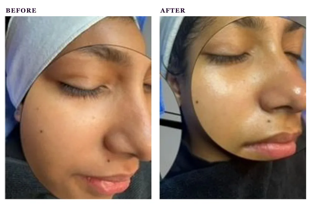 Before and after photos of a raspberry enzyme facial treatment