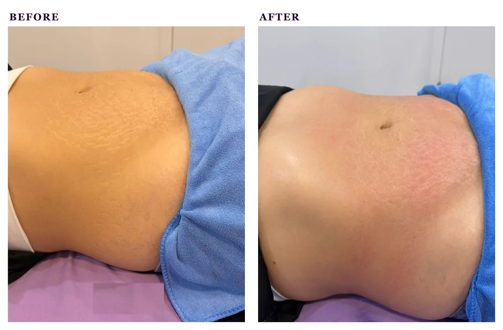 Before and after photos of radio frequency treatment for stretch marks
